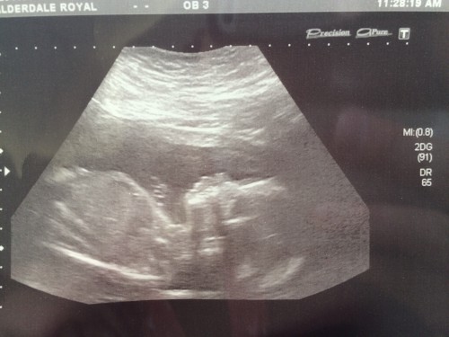 A 20 week ultrasound image of our baby
