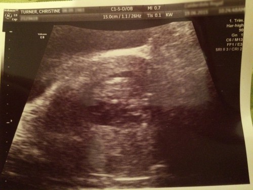 An ultrasound scan of our baby, taken at around 11 weeks of gestation